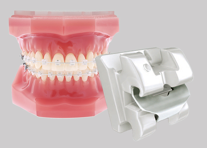 클리피씨 교정(세라믹 브라켓)